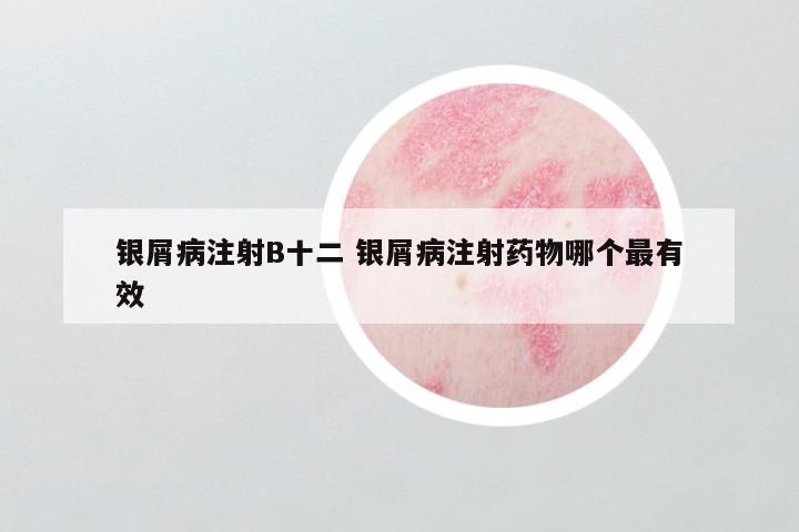 银屑病注射B十二 银屑病注射药物哪个最有效