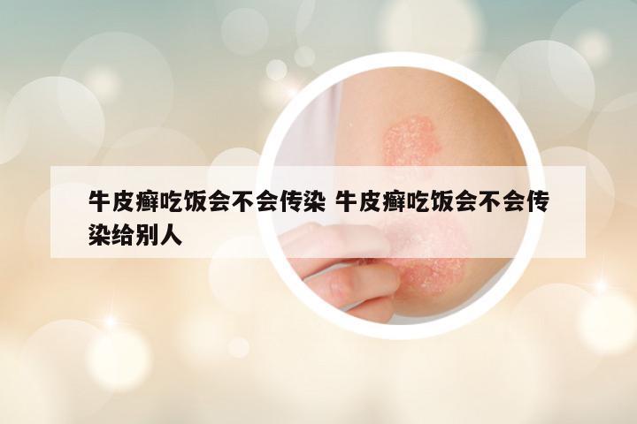 牛皮癣吃饭会不会传染 牛皮癣吃饭会不会传染给别人