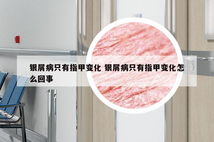 银屑病只有指甲变化 银屑病只有指甲变化怎么回事