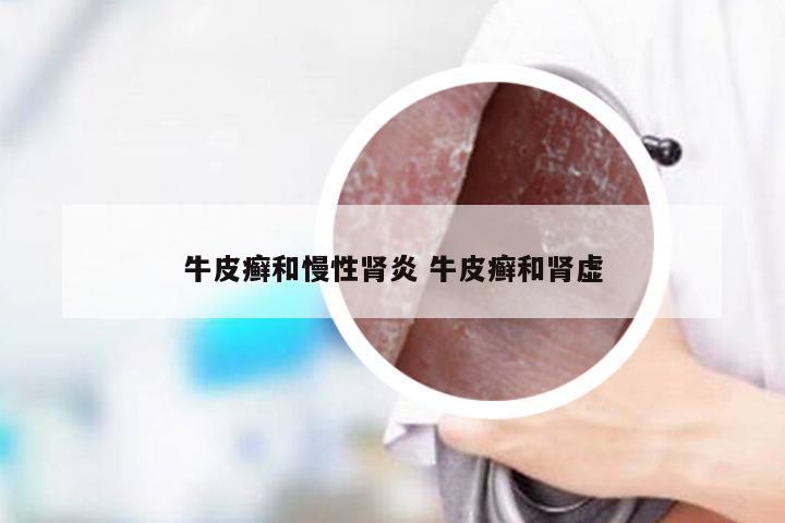 牛皮癣和慢性肾炎 牛皮癣和肾虚