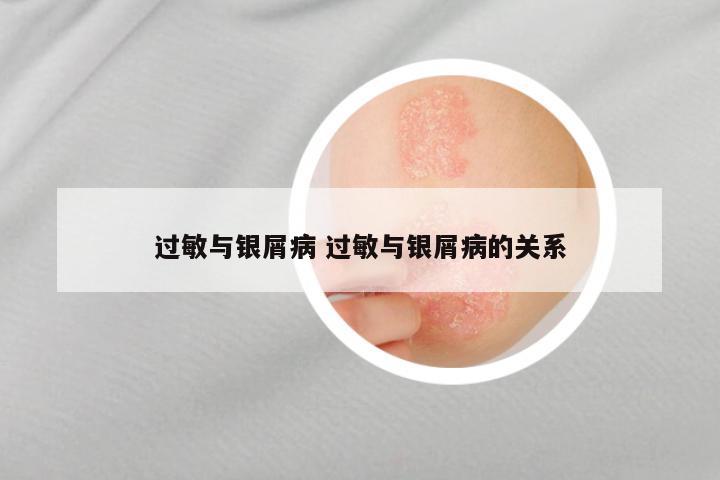 过敏与银屑病 过敏与银屑病的关系