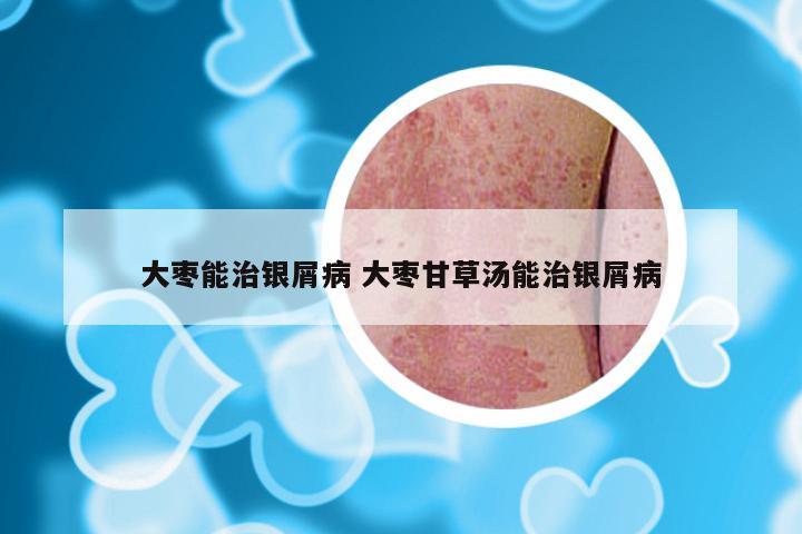 大枣能治银屑病 大枣甘草汤能治银屑病