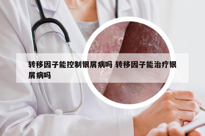 转移因子能控制银屑病吗 转移因子能治疗银屑病吗
