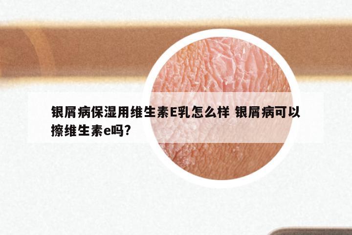 银屑病保湿用维生素E乳怎么样 银屑病可以擦维生素e吗?