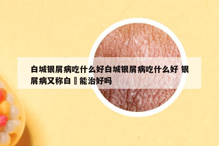白城银屑病吃什么好白城银屑病吃什么好 银屑病又称白疕能治好吗