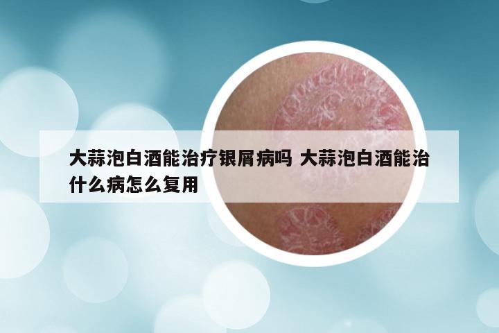大蒜泡白酒能治疗银屑病吗 大蒜泡白酒能治什么病怎么复用