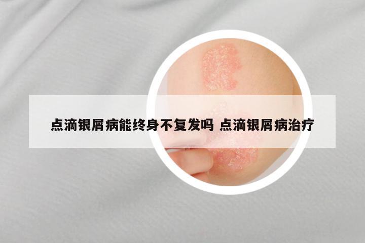 点滴银屑病能终身不复发吗 点滴银屑病治疗