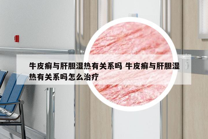 牛皮癣与肝胆湿热有关系吗 牛皮癣与肝胆湿热有关系吗怎么治疗