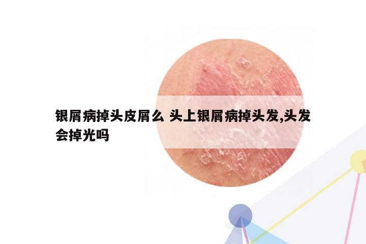 银屑病掉头皮屑么 头上银屑病掉头发,头发会掉光吗