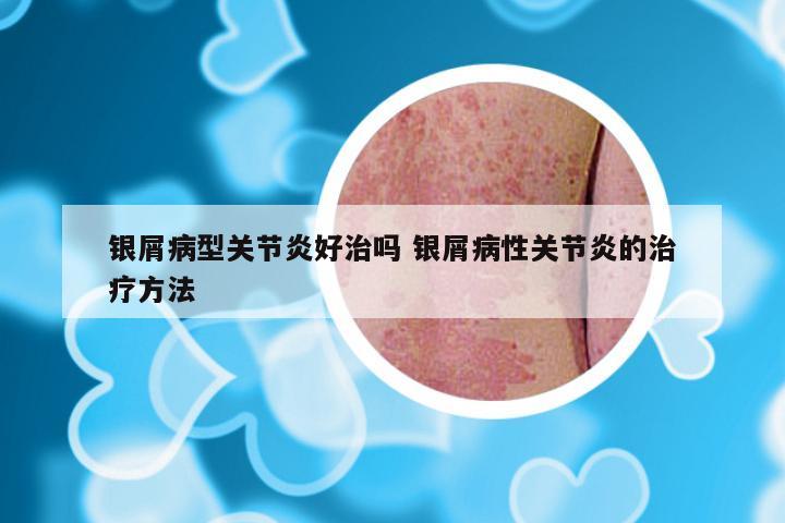银屑病型关节炎好治吗 银屑病性关节炎的治疗方法