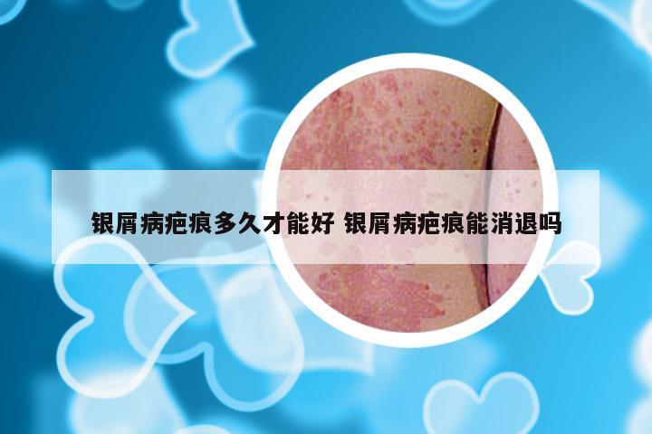 银屑病疤痕多久才能好 银屑病疤痕能消退吗