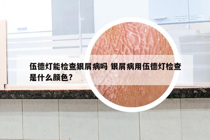 伍德灯能检查银屑病吗 银屑病用伍德灯检查是什么颜色?