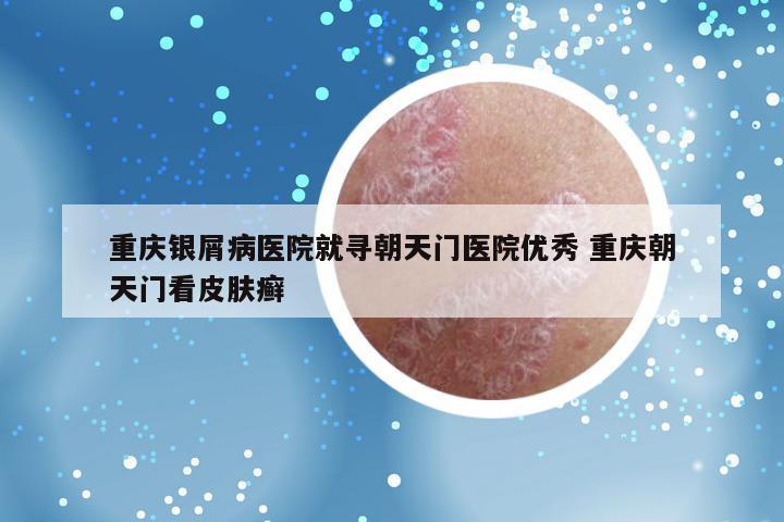 重庆银屑病医院就寻朝天门医院优秀 重庆朝天门看皮肤癣