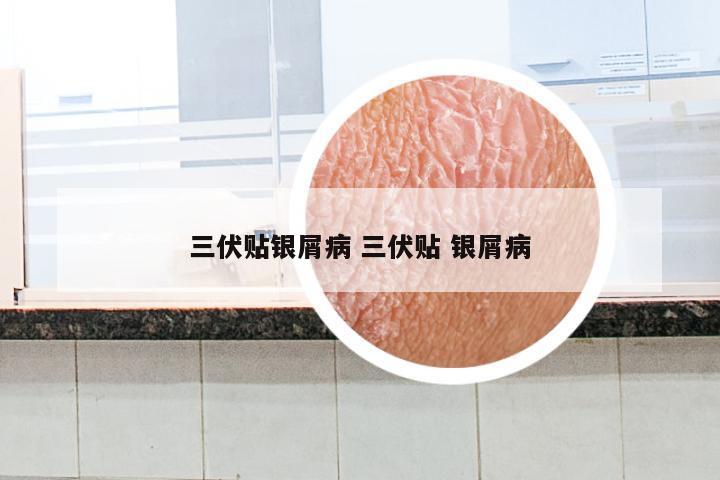 三伏贴银屑病 三伏贴 银屑病