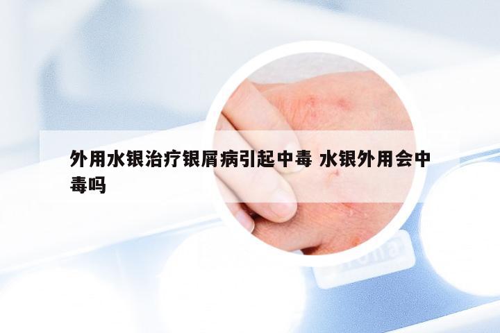外用水银治疗银屑病引起中毒 水银外用会中毒吗