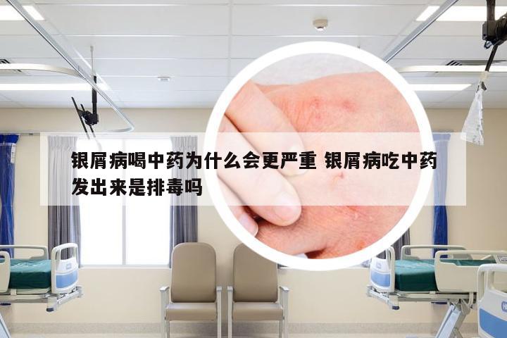 银屑病喝中药为什么会更严重 银屑病吃中药发出来是排毒吗