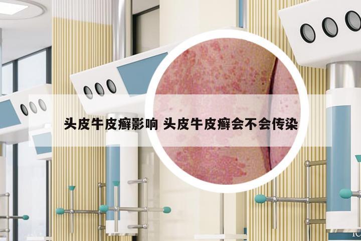 头皮牛皮癣影响 头皮牛皮癣会不会传染