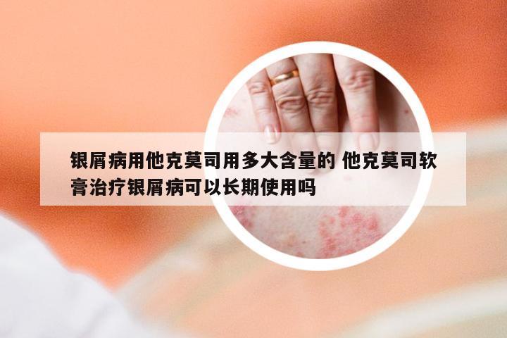 银屑病用他克莫司用多大含量的 他克莫司软膏治疗银屑病可以长期使用吗
