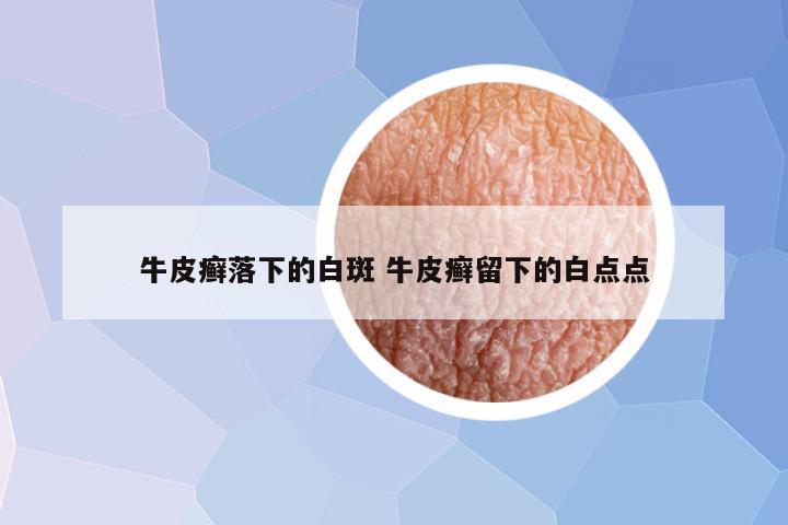 牛皮癣落下的白斑 牛皮癣留下的白点点