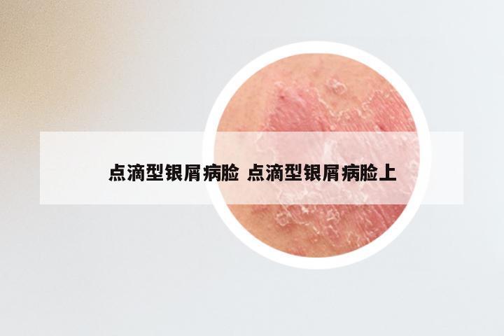 点滴型银屑病脸 点滴型银屑病脸上