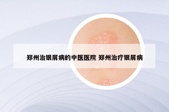 郑州治银屑病的中医医院 郑州治疗银屑病