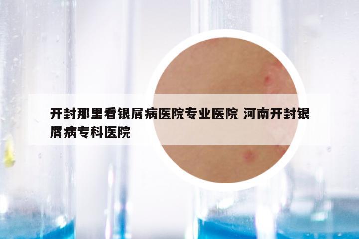 开封那里看银屑病医院专业医院 河南开封银屑病专科医院
