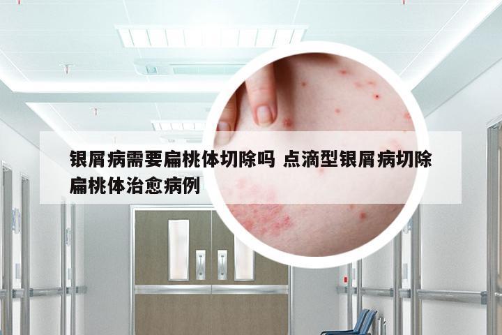 银屑病需要扁桃体切除吗 点滴型银屑病切除扁桃体治愈病例