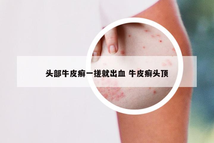 头部牛皮癣一搓就出血 牛皮癣头顶