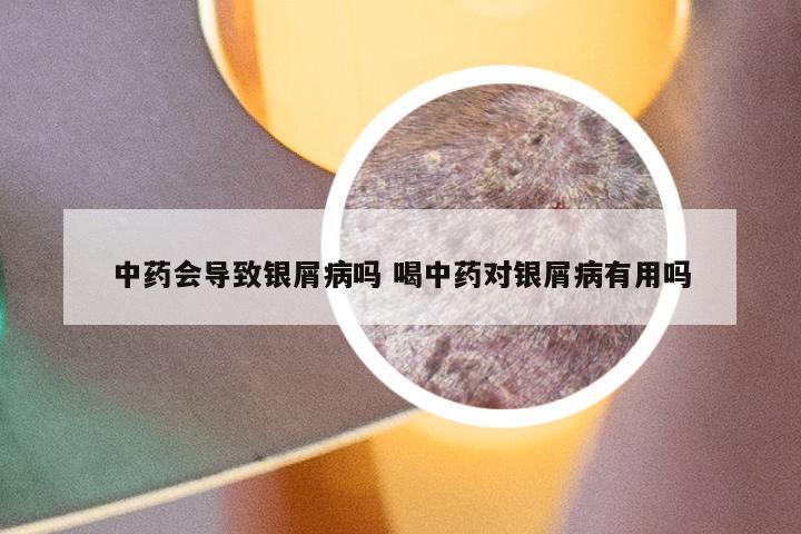 中药会导致银屑病吗 喝中药对银屑病有用吗