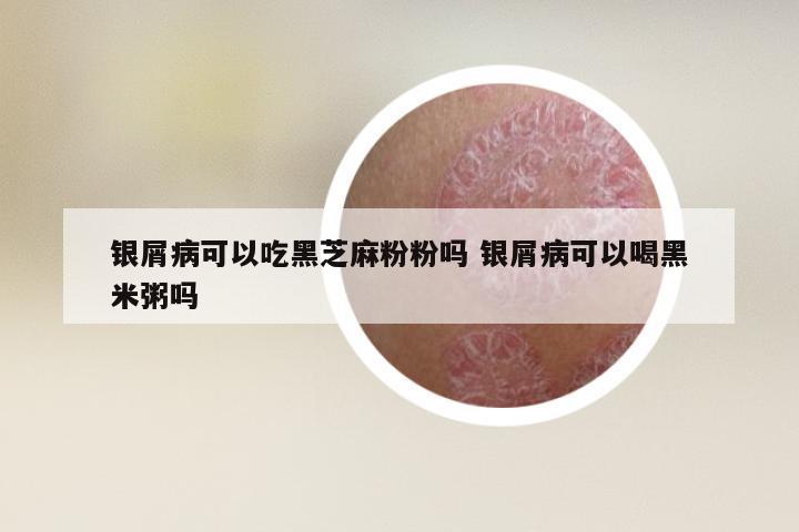 银屑病可以吃黑芝麻粉粉吗 银屑病可以喝黑米粥吗