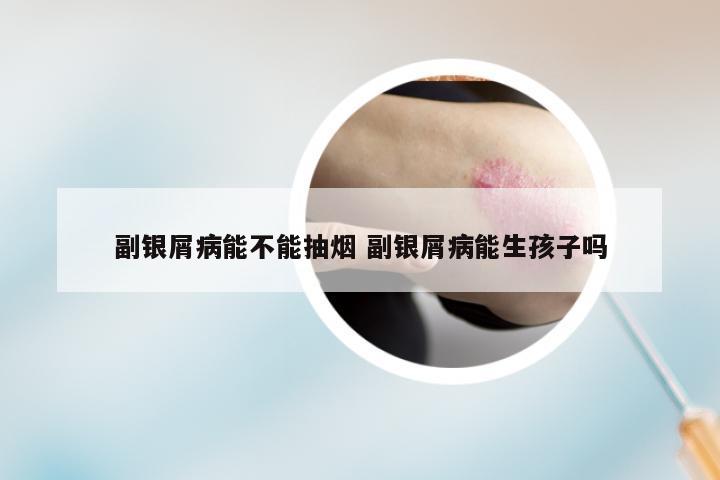 副银屑病能不能抽烟 副银屑病能生孩子吗