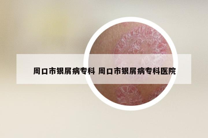 周口市银屑病专科 周口市银屑病专科医院
