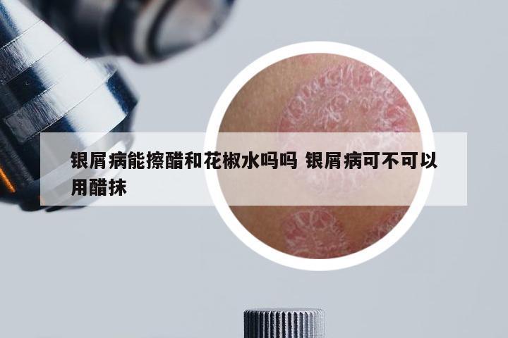 银屑病能擦醋和花椒水吗吗 银屑病可不可以用醋抹