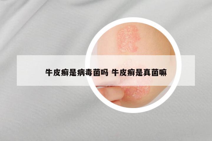 牛皮癣是病毒菌吗 牛皮癣是真菌嘛