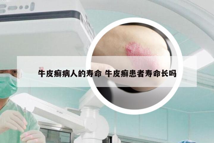 牛皮癣病人的寿命 牛皮癣患者寿命长吗