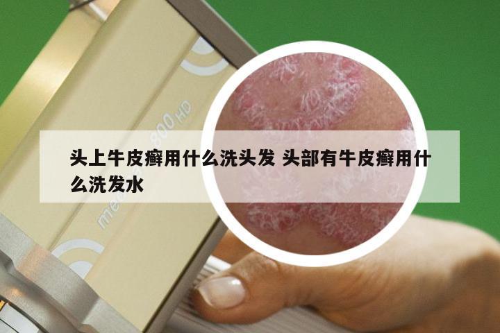 头上牛皮癣用什么洗头发 头部有牛皮癣用什么洗发水
