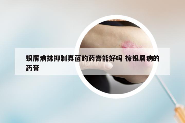 银屑病抹抑制真菌的药膏能好吗 擦银屑病的药膏
