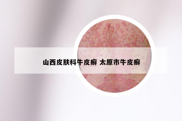 山西皮肤科牛皮癣 太原市牛皮癣