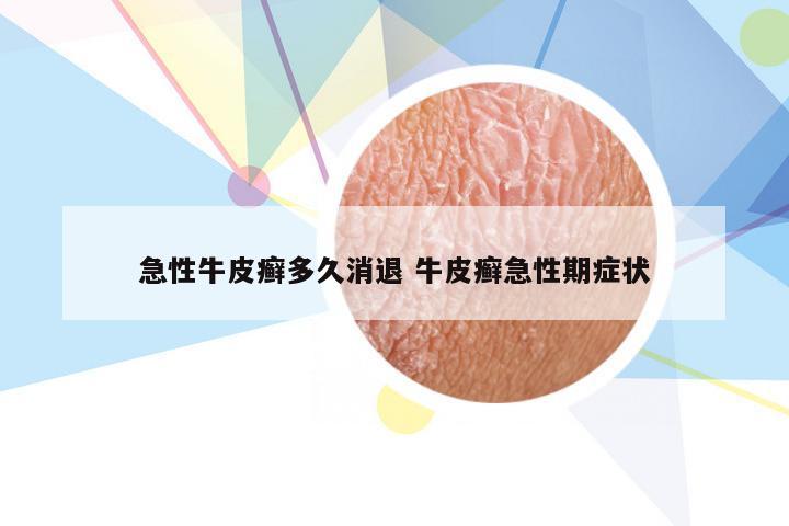 急性牛皮癣多久消退 牛皮癣急性期症状