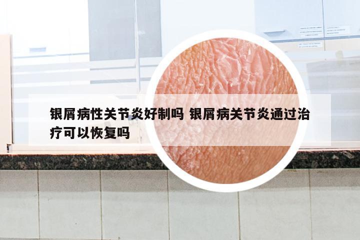 银屑病性关节炎好制吗 银屑病关节炎通过治疗可以恢复吗