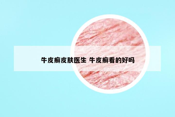 牛皮癣皮肤医生 牛皮癣看的好吗