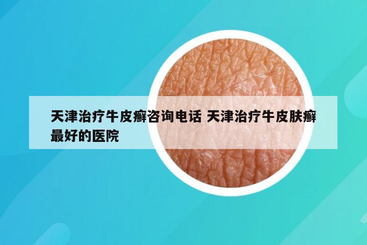 天津治疗牛皮癣咨询电话 天津治疗牛皮肤癣最好的医院
