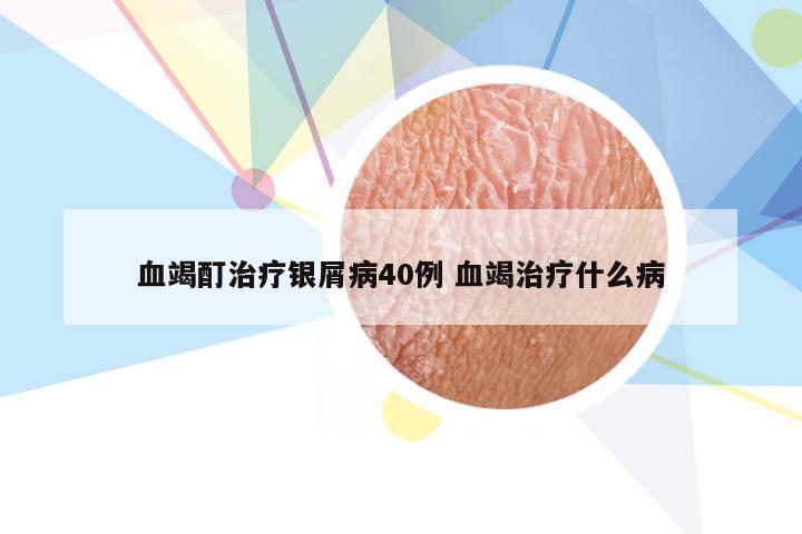 血竭酊治疗银屑病40例 血竭治疗什么病