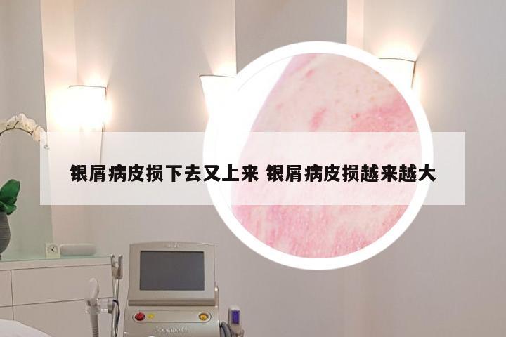 银屑病皮损下去又上来 银屑病皮损越来越大