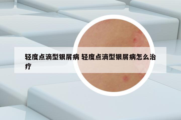 轻度点滴型银屑病 轻度点滴型银屑病怎么治疗