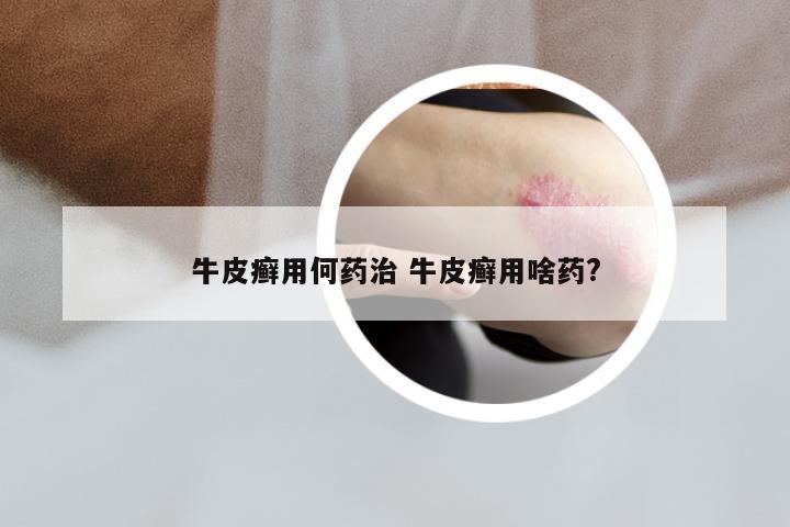 牛皮癣用何药治 牛皮癣用啥药?