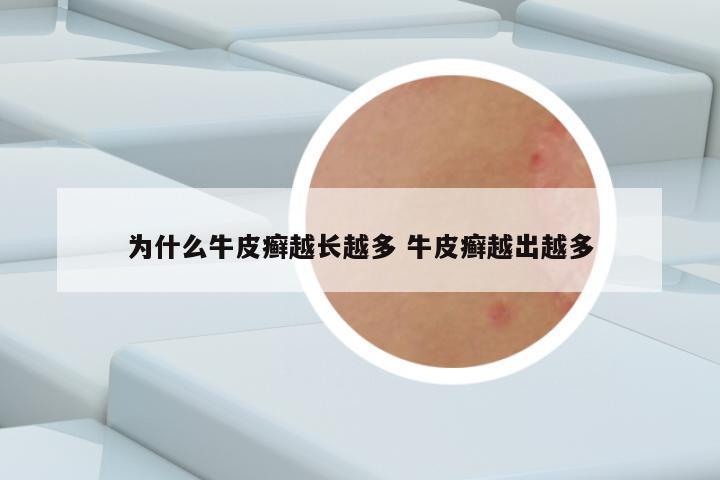 为什么牛皮癣越长越多 牛皮癣越出越多