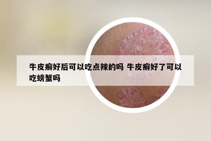 牛皮癣好后可以吃点辣的吗 牛皮癣好了可以吃螃蟹吗