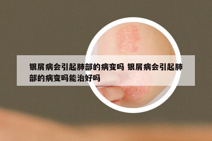 银屑病会引起肺部的病变吗 银屑病会引起肺部的病变吗能治好吗