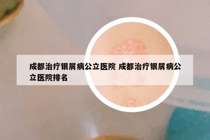 成都治疗银屑病公立医院 成都治疗银屑病公立医院排名